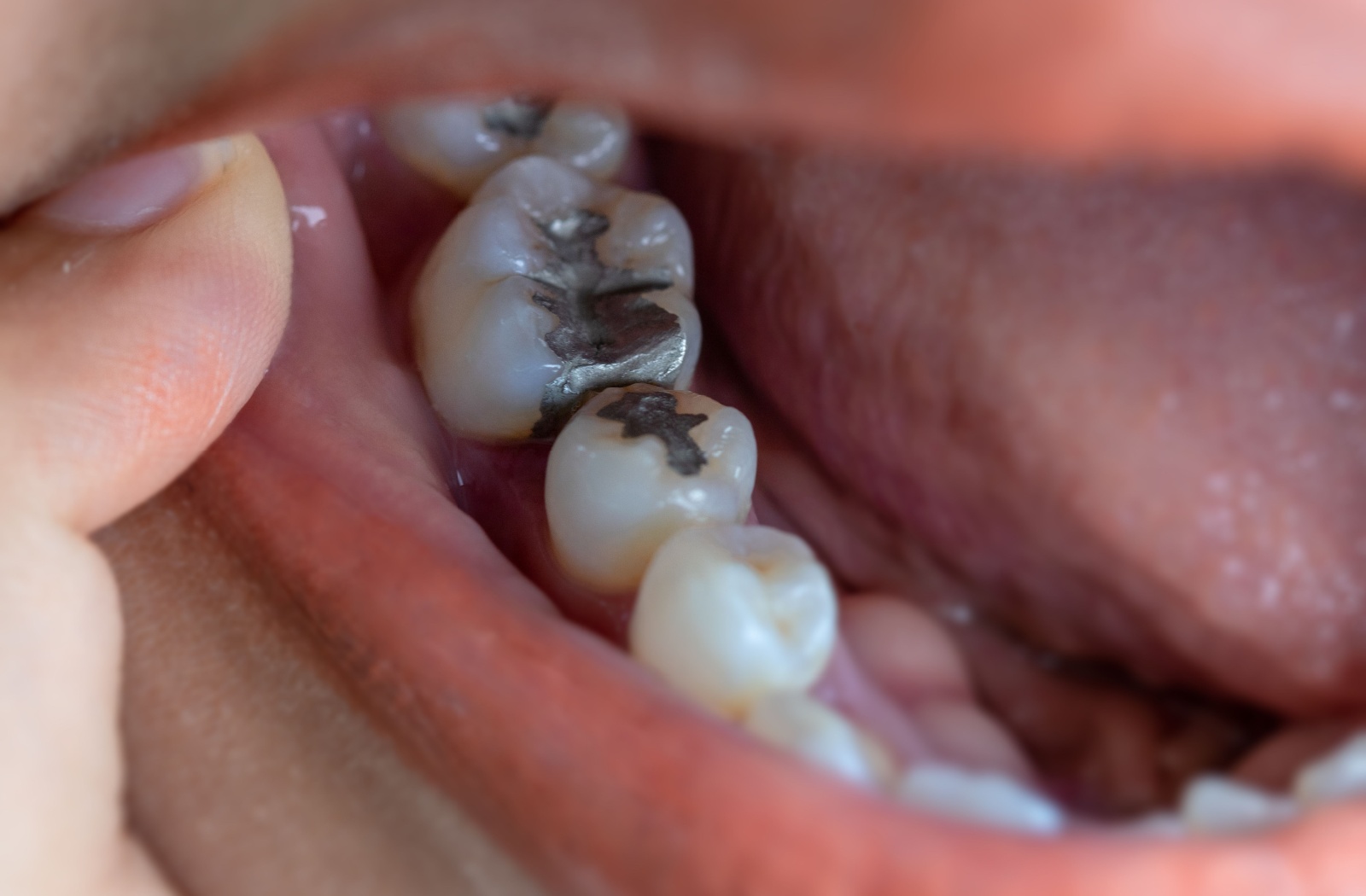 Someone pulls their cheek back to reveal a number of amalgam fillings that have been performed on their molar teeth. These fillings are smooth and silver, sometimes with a light shine to them.