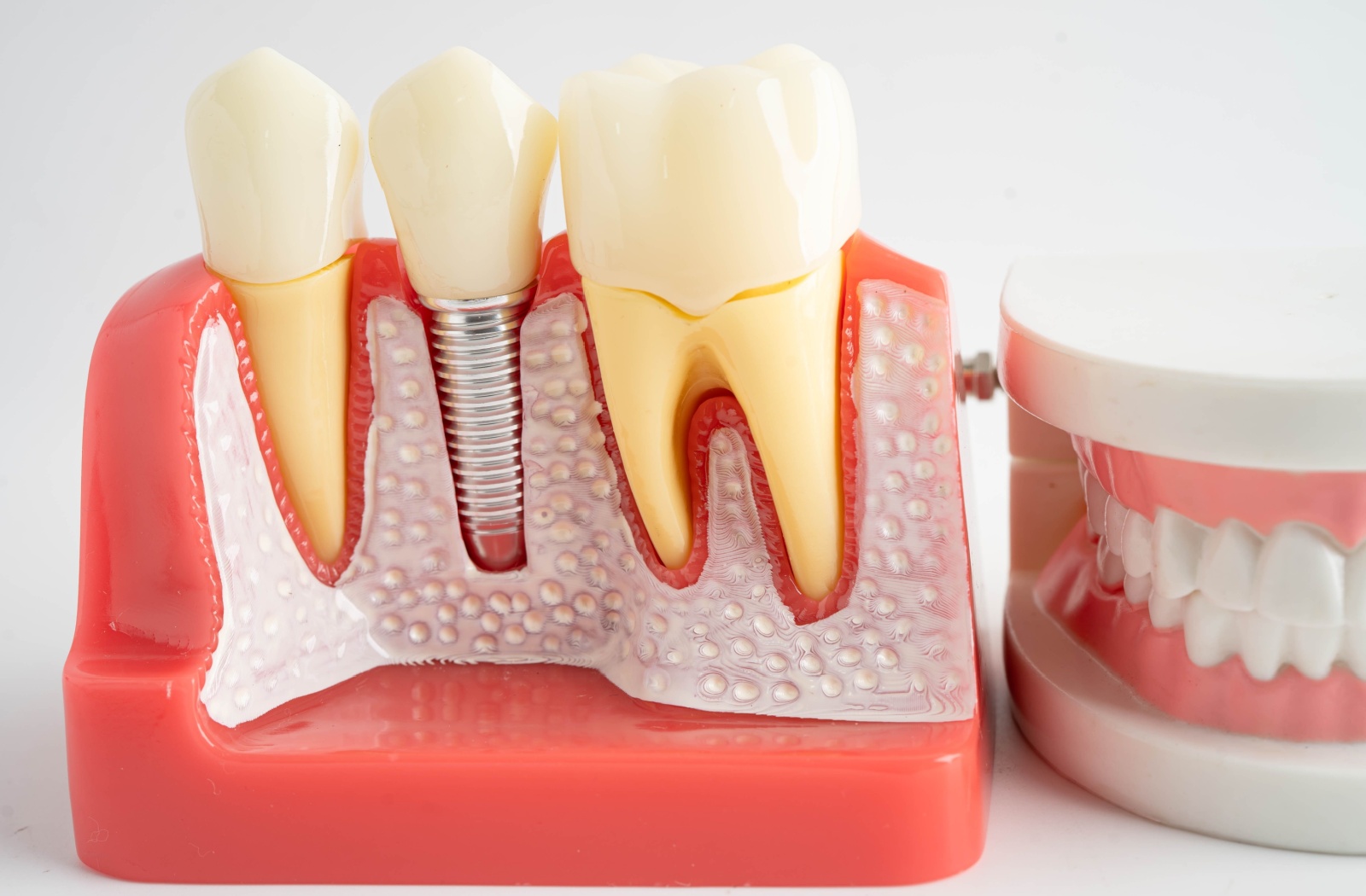 Cross sectional model of teeth including a dental implant, shown as a screw-like device plugged into the jawbone.