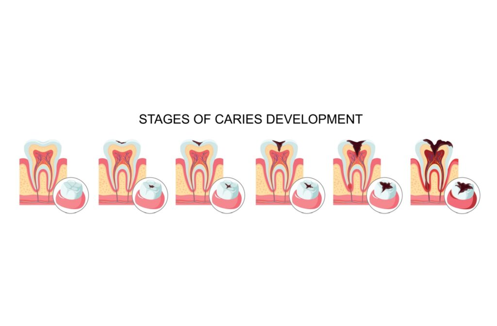 Illustration showing the stages of tooth decay and cavity development from early enamel damage to advanced caries.