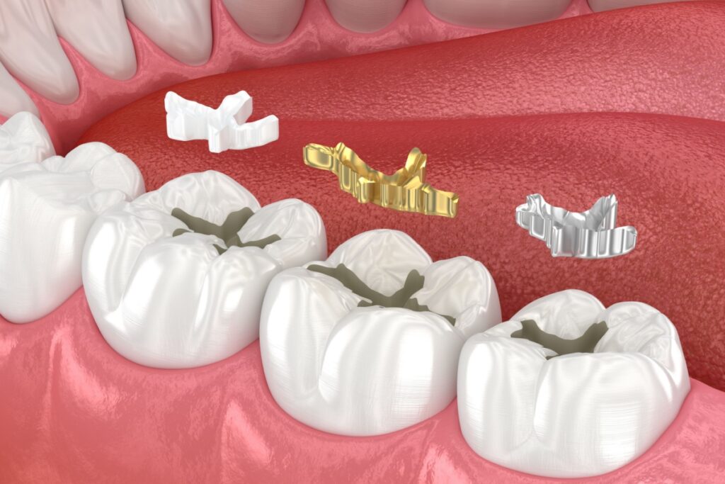 A 3D rendering of different materials being used for a dental filling.