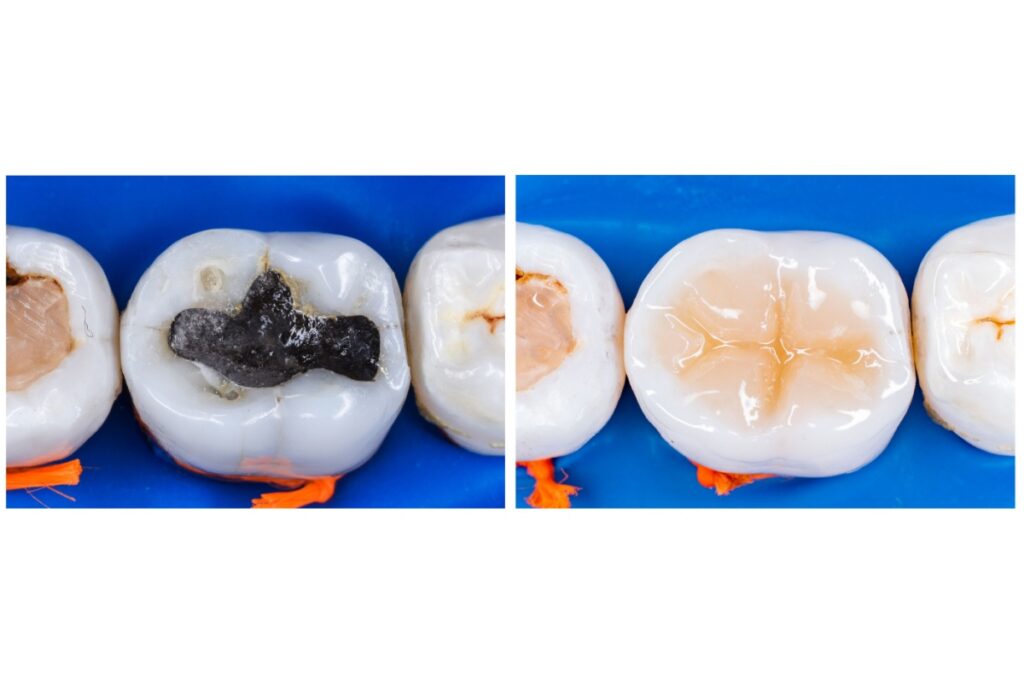 Three-dimensional molar tooth model showing dark amalgam filling on occlusal chewing surface against blue background.