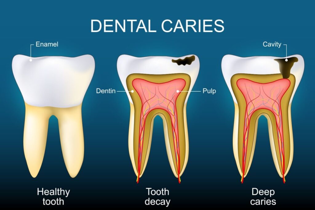 Stages of dental caries graphic.